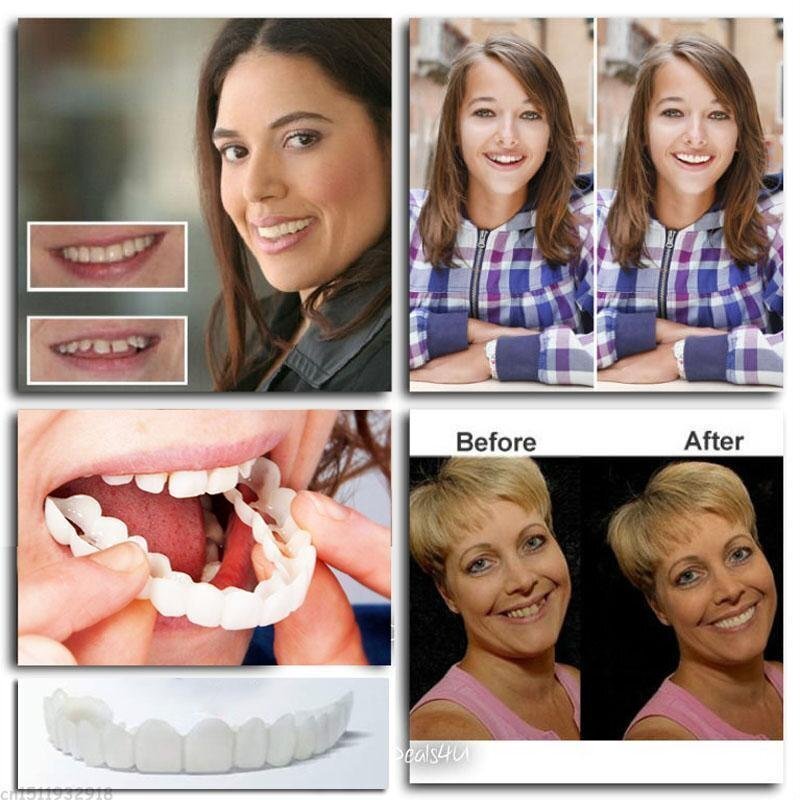 SmileEase Snap-On Teeth Covers – Adjustable, Natural-Looking Temporary Smile Enhancer