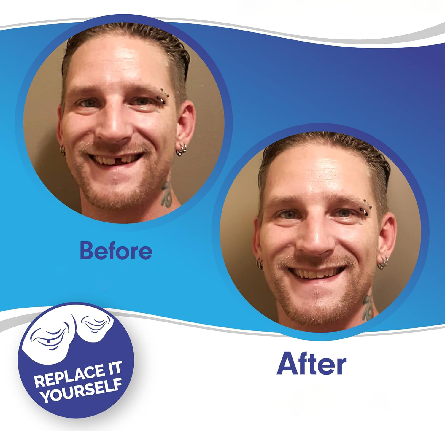 Radiant Smile Veneers – Complete Upper & Lower Set