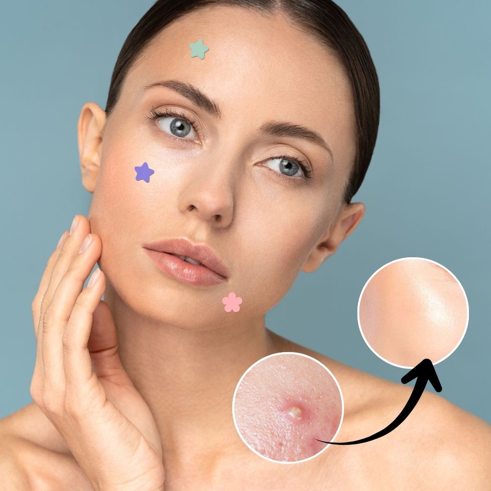 Starry Skin Repair Pimple Treatment Patches