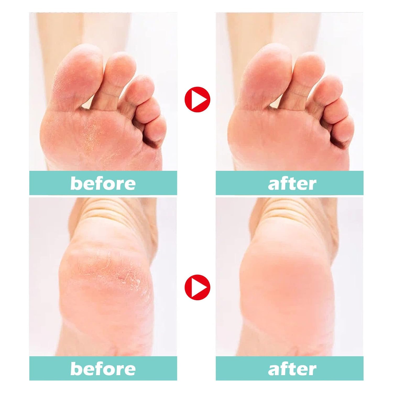 Callus Remover Cream Salicylic Acid & Plant Oils