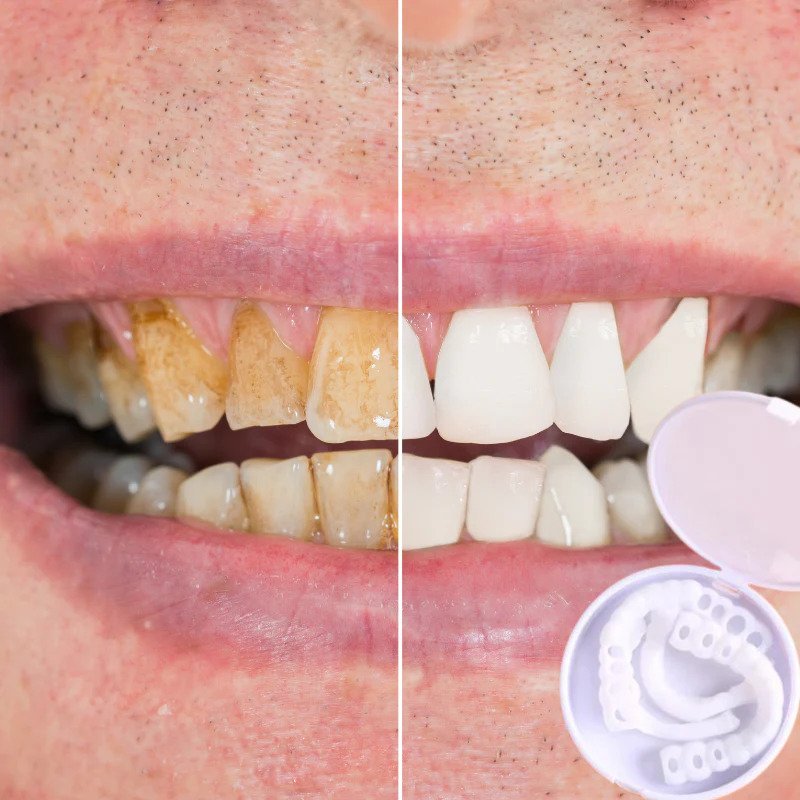 Cosmetic Veneers Snap-On Flexible Upper & Lower Set