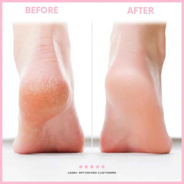 Foot Callus Remover Gentle Exfoliating Electric Stainless Steel Head