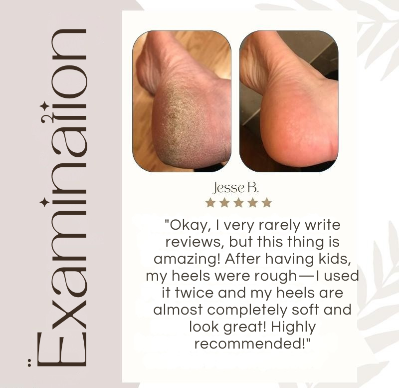 Foot Callus Remover Quartz Rollers Rechargeable Dual Heads