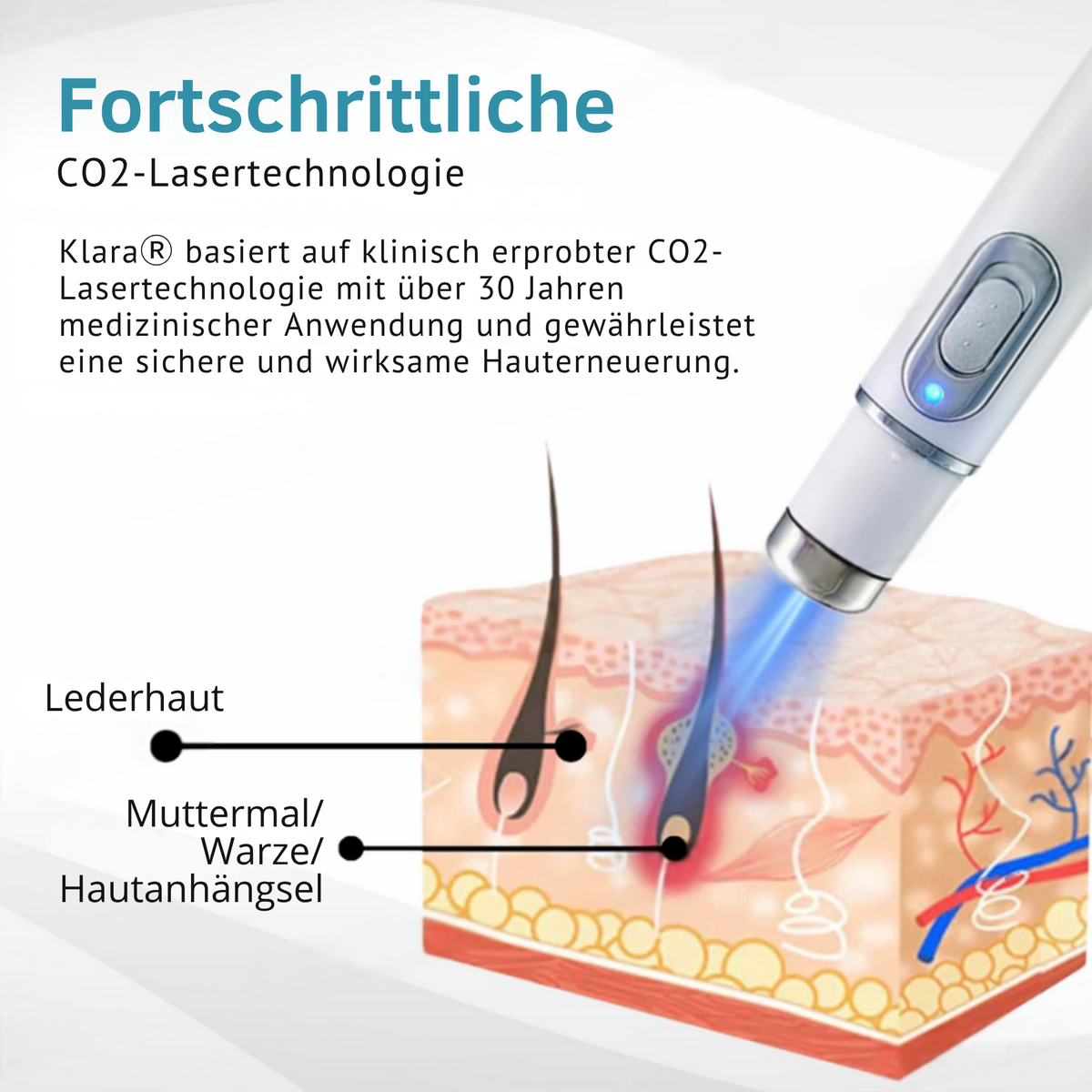 Laser Pen Painless Mole, Skin Tag & Wart Remover