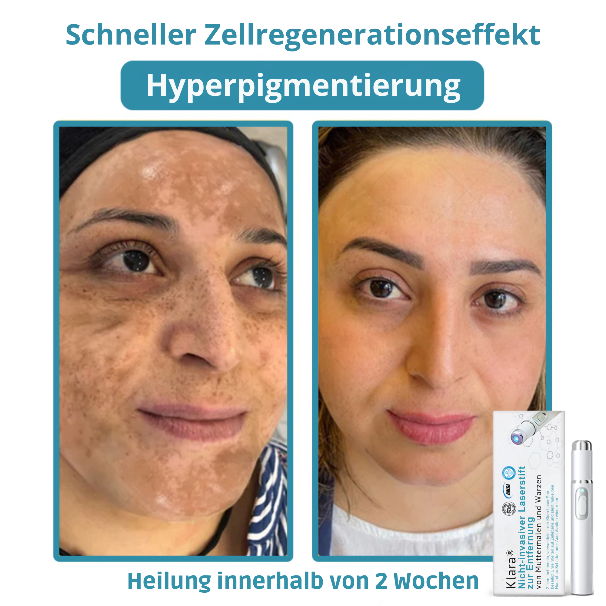 Laser Pen Painless Mole, Skin Tag & Wart Remover