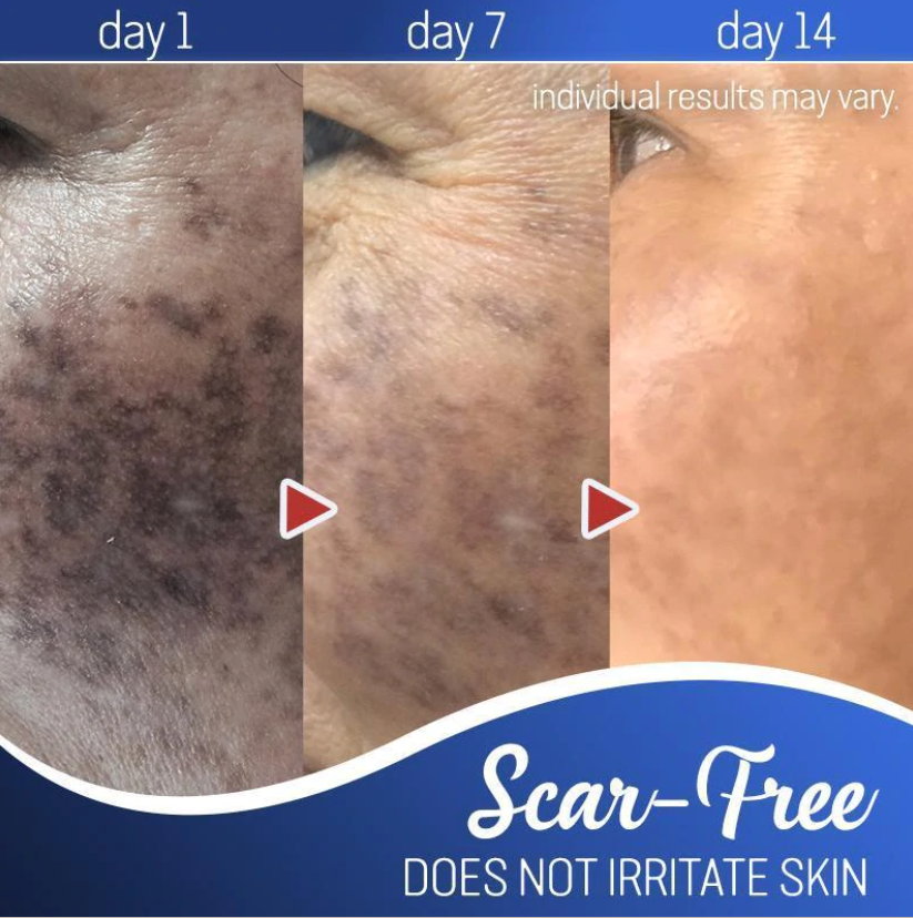 Mole Removal Cream Painless Scar-Free Face & Body