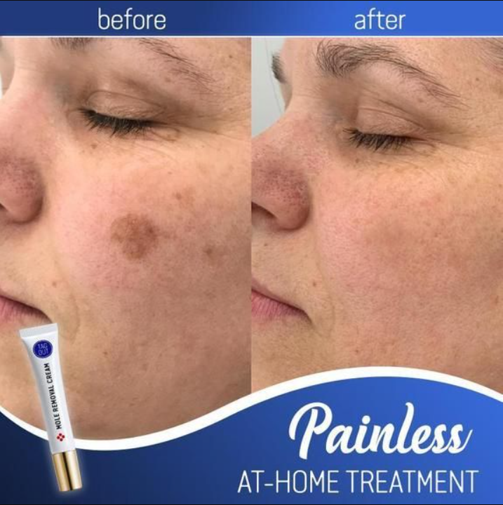 Mole Removal Cream Painless Scar-Free Face & Body