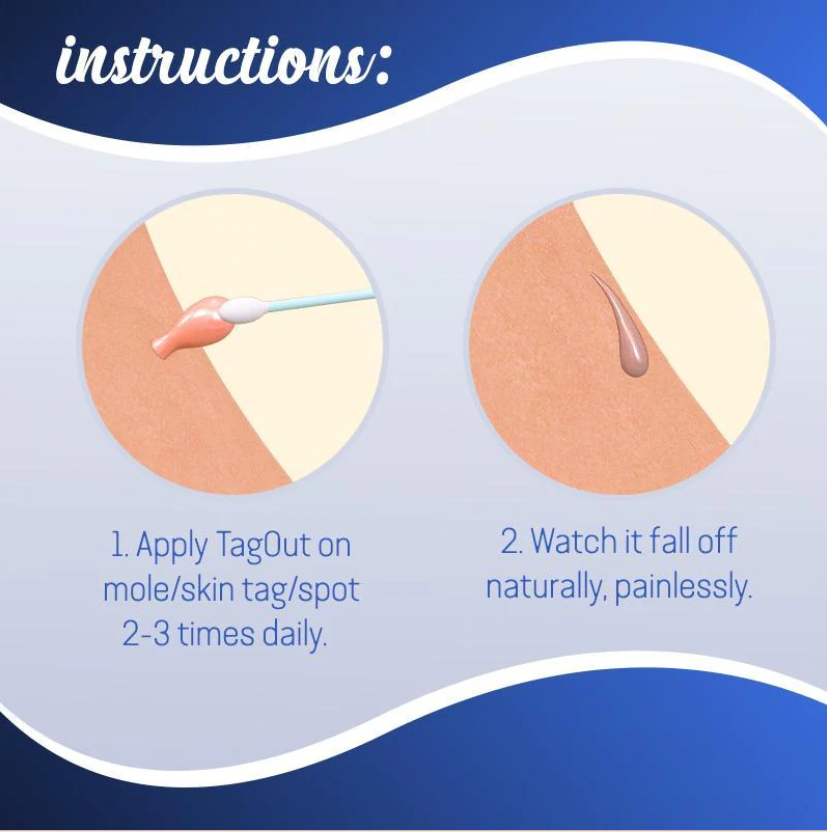 Mole Removal Cream Painless Scar-Free Face & Body