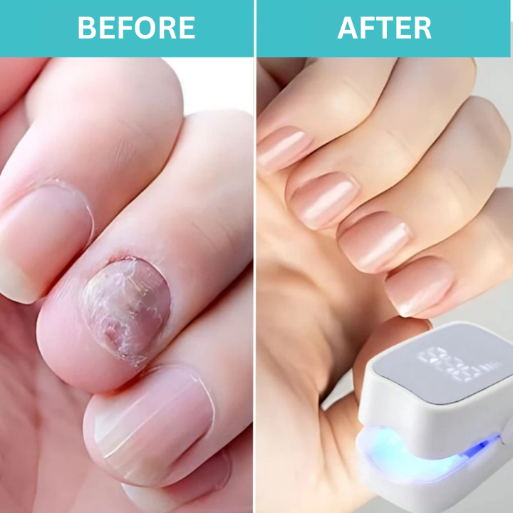Nail Treatment Antifungal Fast-Acting 7-Min Daily