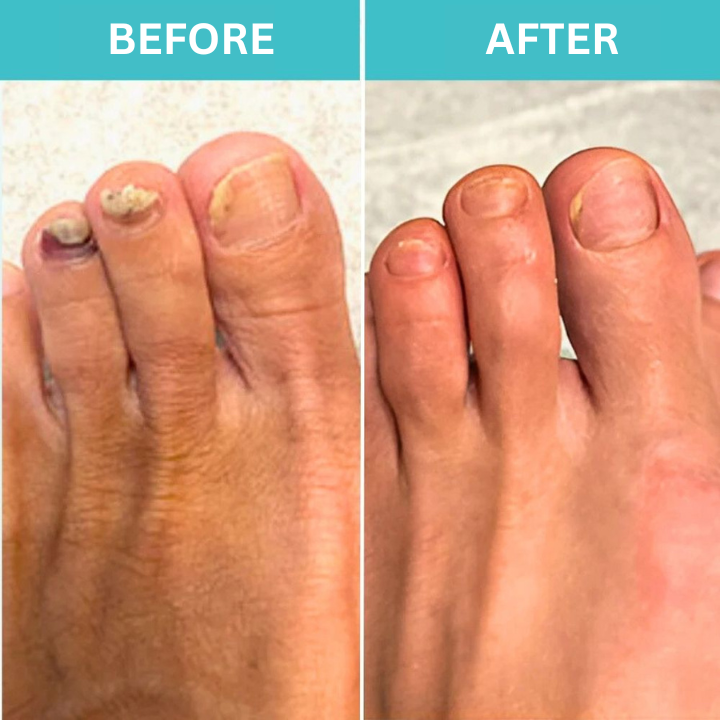 Nail Treatment Antifungal Fast-Acting 7-Min Daily