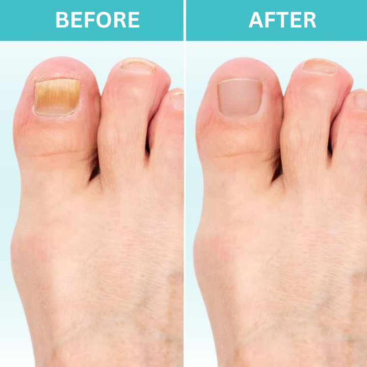 Nail Treatment Antifungal Fast-Acting 7-Min Daily
