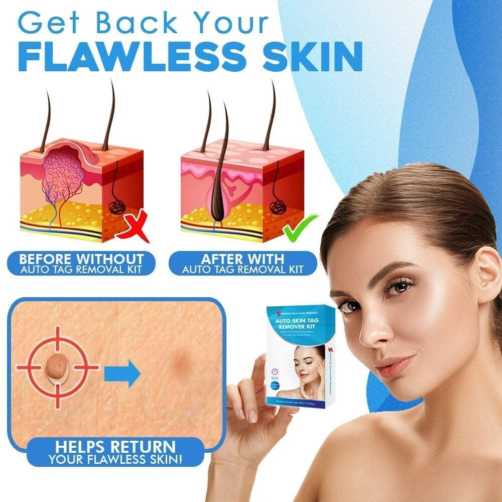 Skin Fibroma Removal Kit Non-Surgical Ligature Bands & One-Handed Applicator