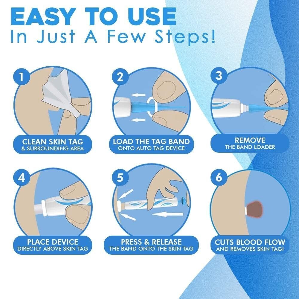Skin Fibroma Removal Kit Non-Surgical Ligature Bands & One-Handed Applicator