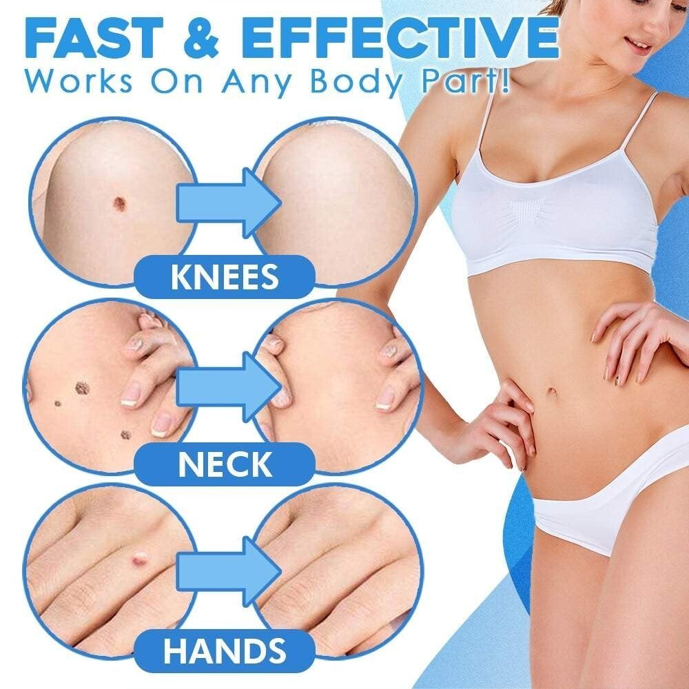 Skin Fibroma Removal Kit Non-Surgical Ligature Bands & One-Handed Applicator