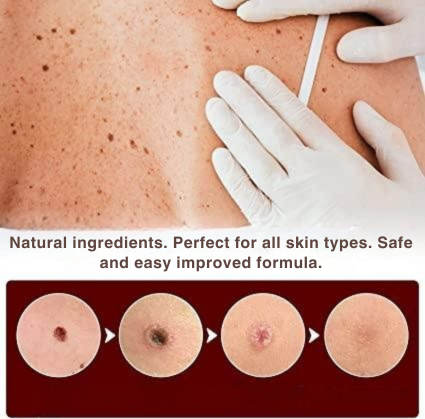 Skin Spot & Wart Remover Precision Applicator Plant-Based Pain-Free