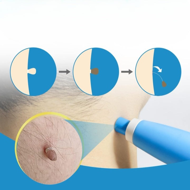 Skin Tag Removal Kit Painless Micro-Compression Scar-Free