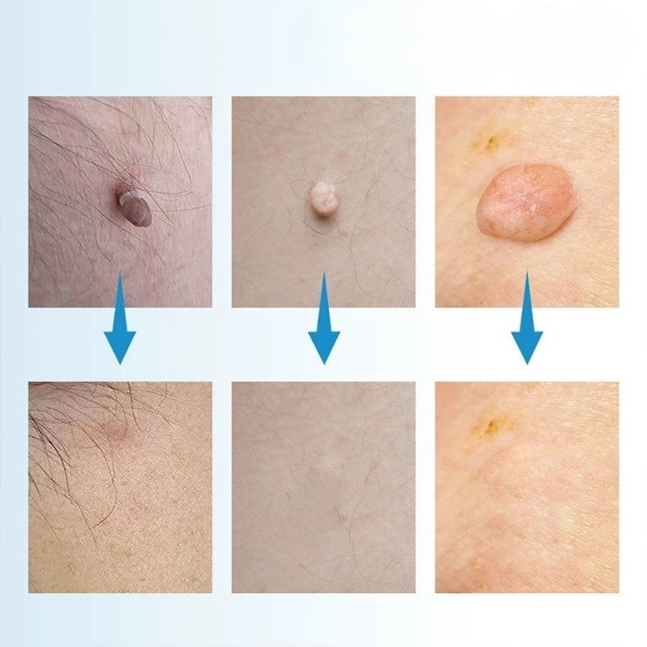 Skin Tag Removal Kit Painless Micro-Compression Scar-Free