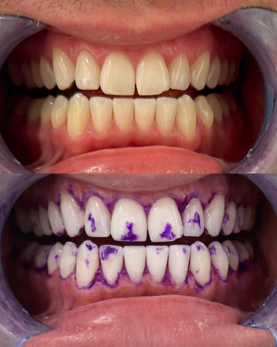 Teeth Whitening Strips Flexible Fit 30-Minute Pack of 14