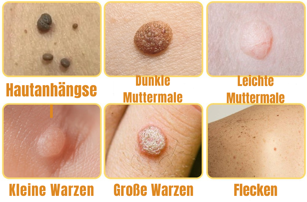 Wart Remover Spray Bee Venom-Inspired Pain-Free 20 ml
