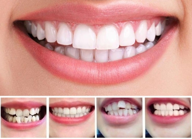 Clear Aligners for At-Home Smile Transformation