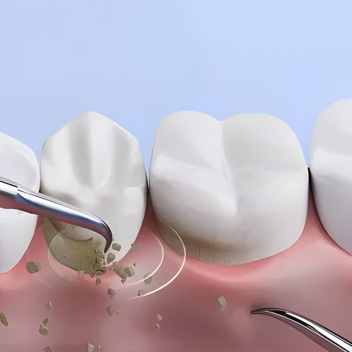 Advanced Ultrasonic Tooth Stain Remover