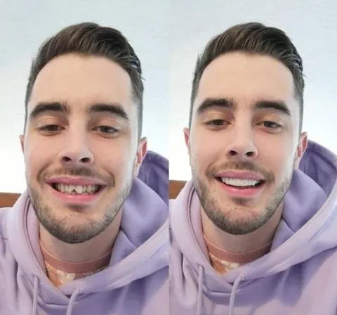 Natural Smile Enhancer | Customizable Veneers for Every Occasion
