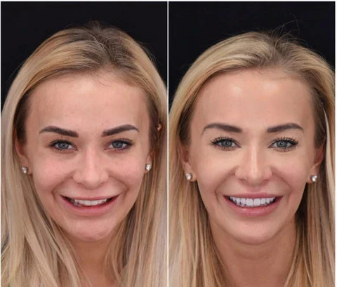 Custom Fit Smile Enhancers for Upper & Lower Teeth