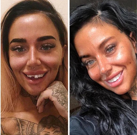 Custom Fit Smile Enhancers for Upper & Lower Teeth
