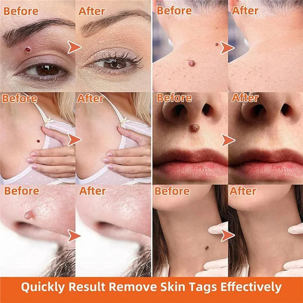 Gentle Skin Tag Elimination Device