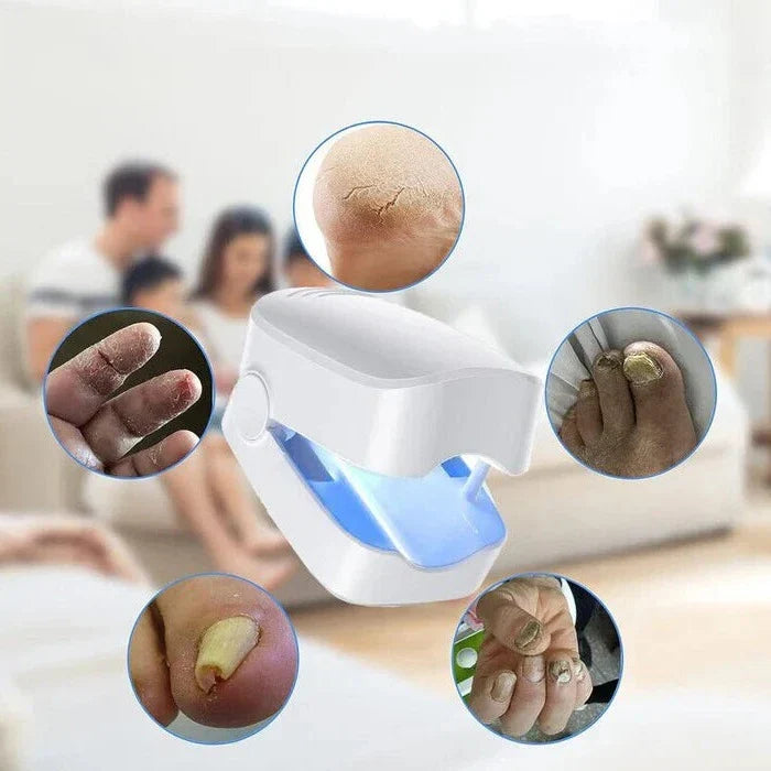 Laser Nail Care Solution - Effective Light Therapy for Fungal Treatment