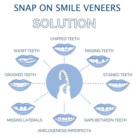Radiant Smile Veneers – Complete Upper & Lower Set