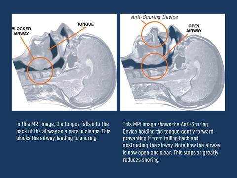 SnoreGuard Tongue Support Device