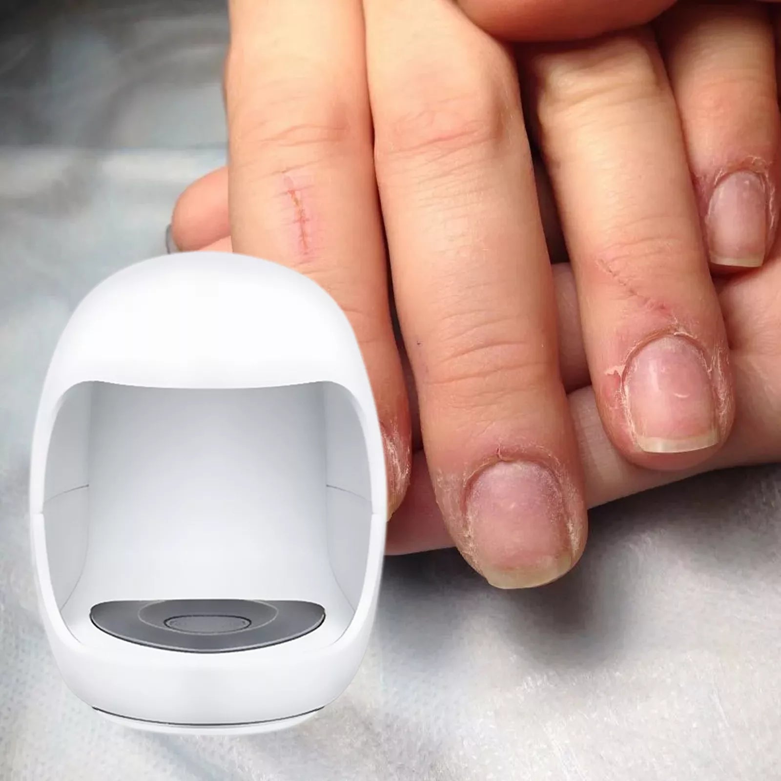 Advanced Laser Treatment Device for Toenail Fungus