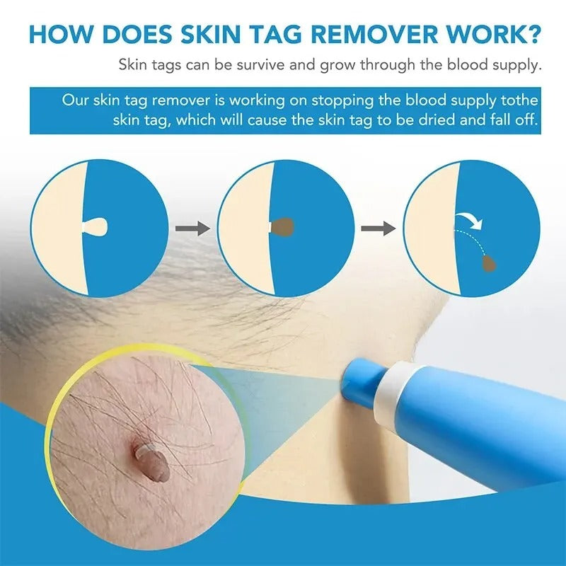 Effortless Skin Tag Eliminator Set