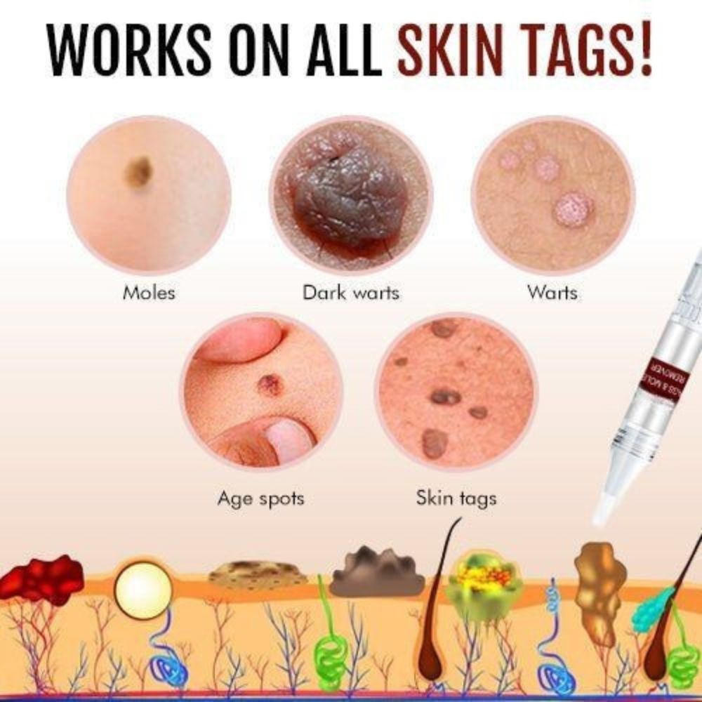 Skin Growth Eliminator for Home Use