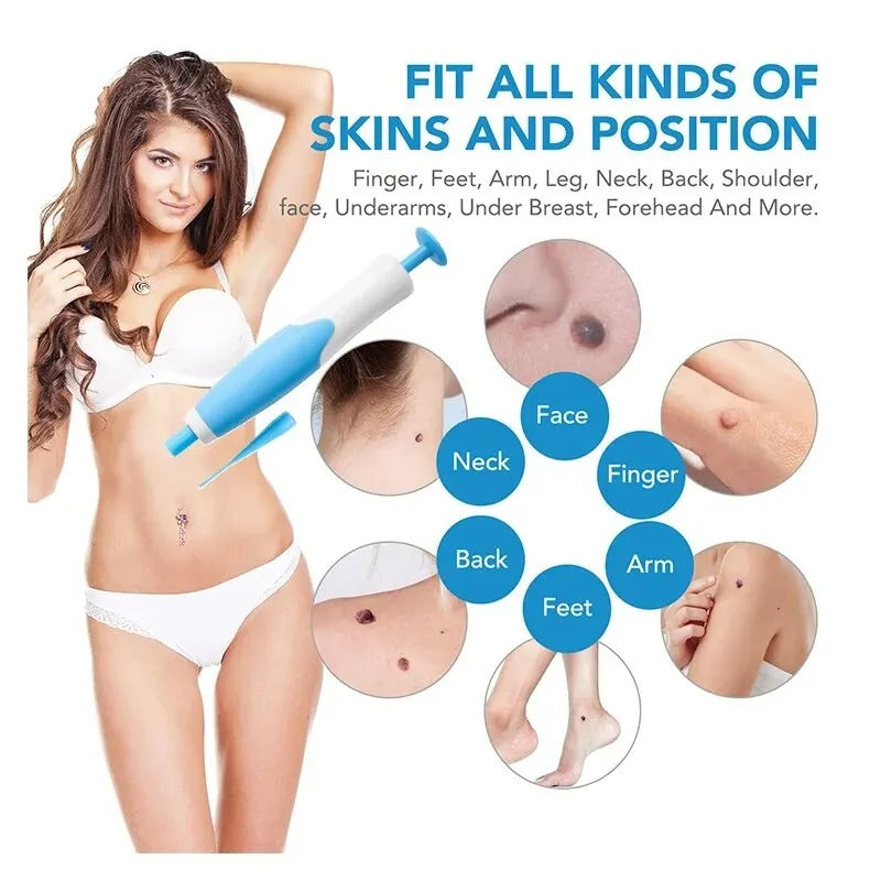Effortless Skin Tag Eliminator Set