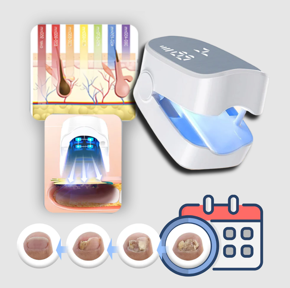 Gentle Nail Care Laser Device for Fungus Relief