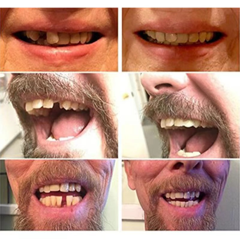 Affordable and Reliable Temporary Tooth Solution
