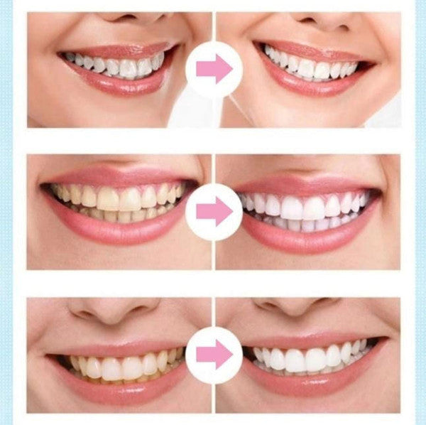 BrightSmile Teeth Whitening Pen