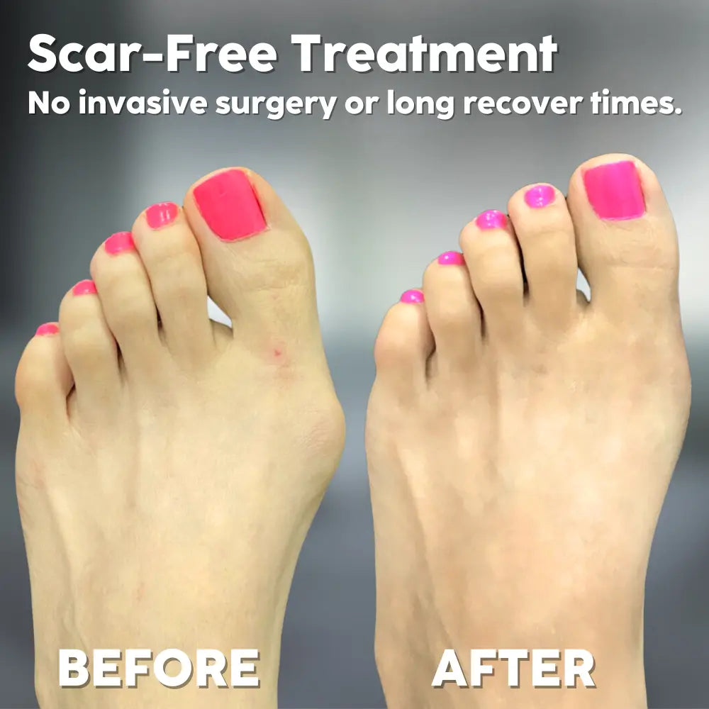 Bunion Corrector Soft Silicone Toe Aligner
