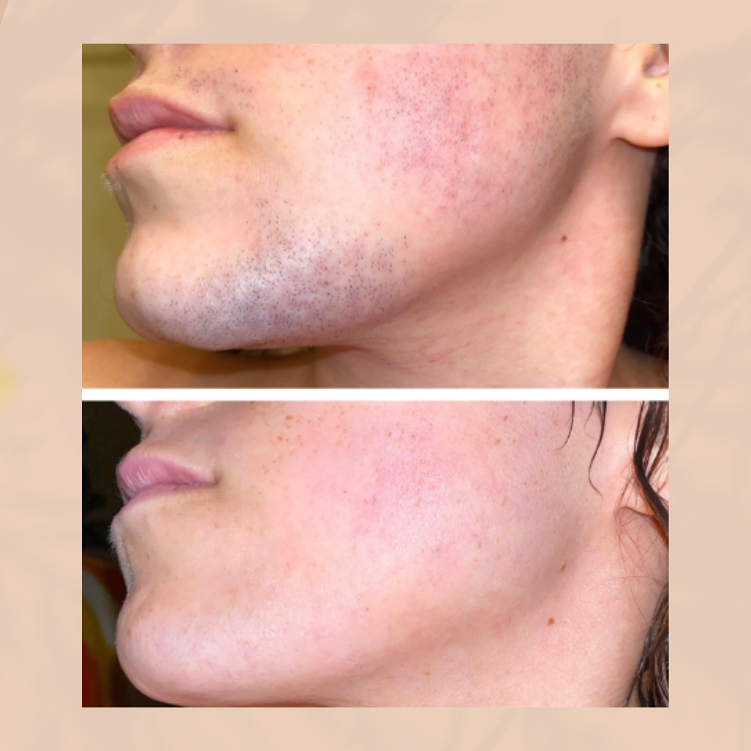 Hair Removal Cream Prevents Ingrown Hairs Soothing Gel