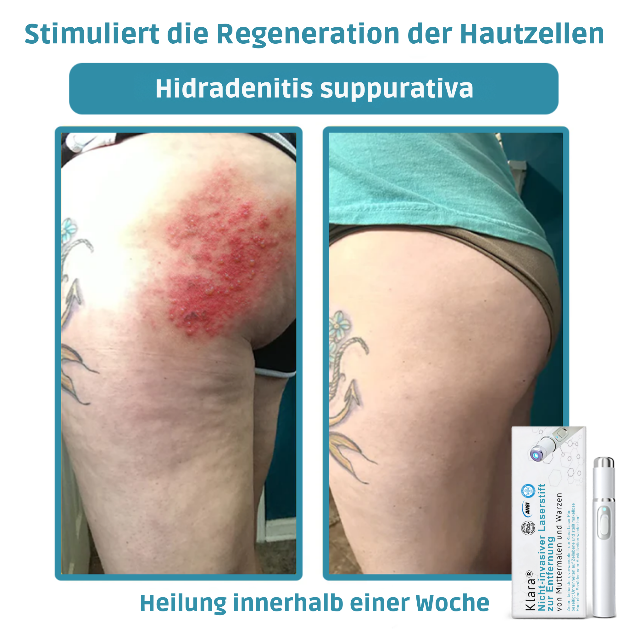 Laser Pen Painless Mole, Skin Tag & Wart Remover