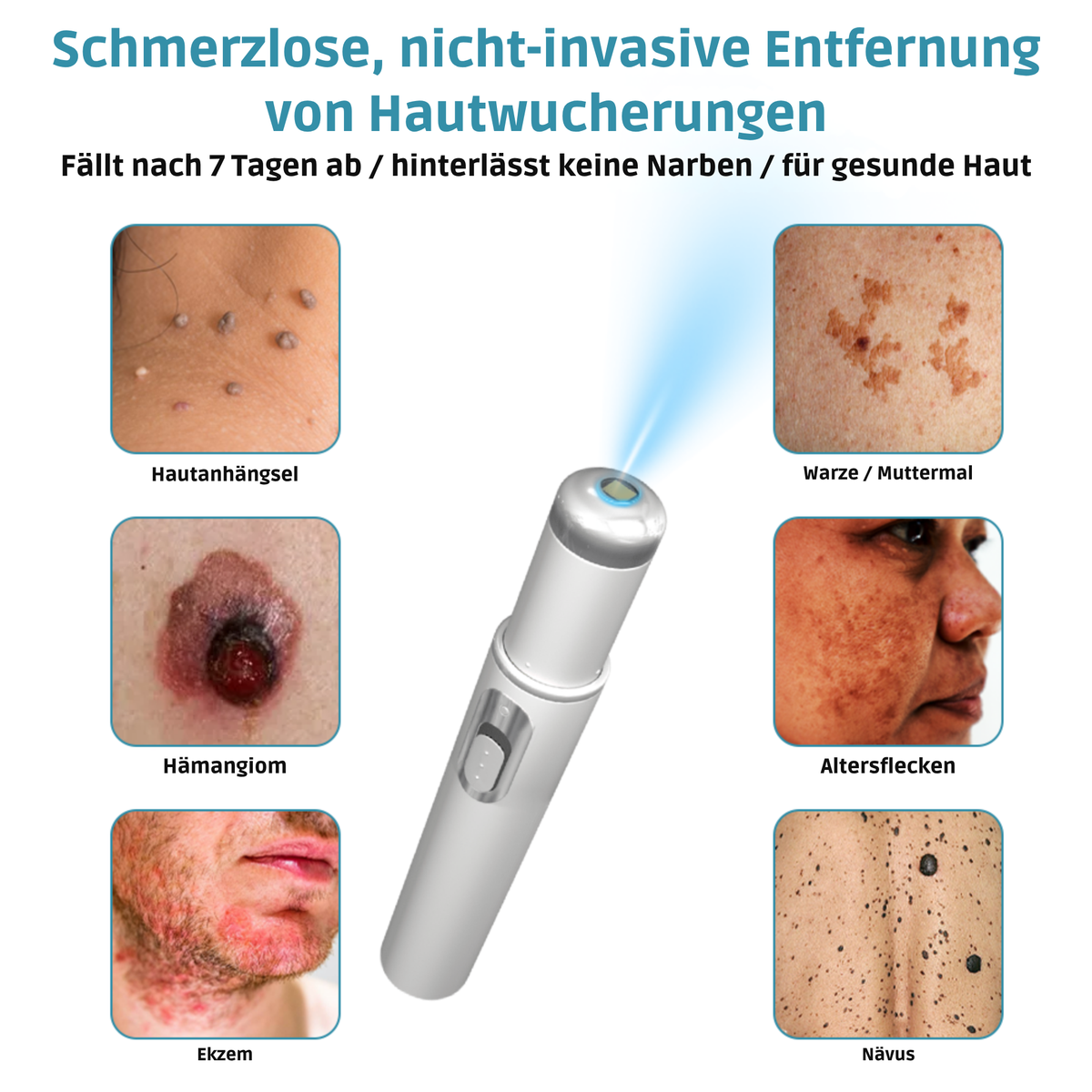 Laser Pen Painless Mole, Skin Tag & Wart Remover