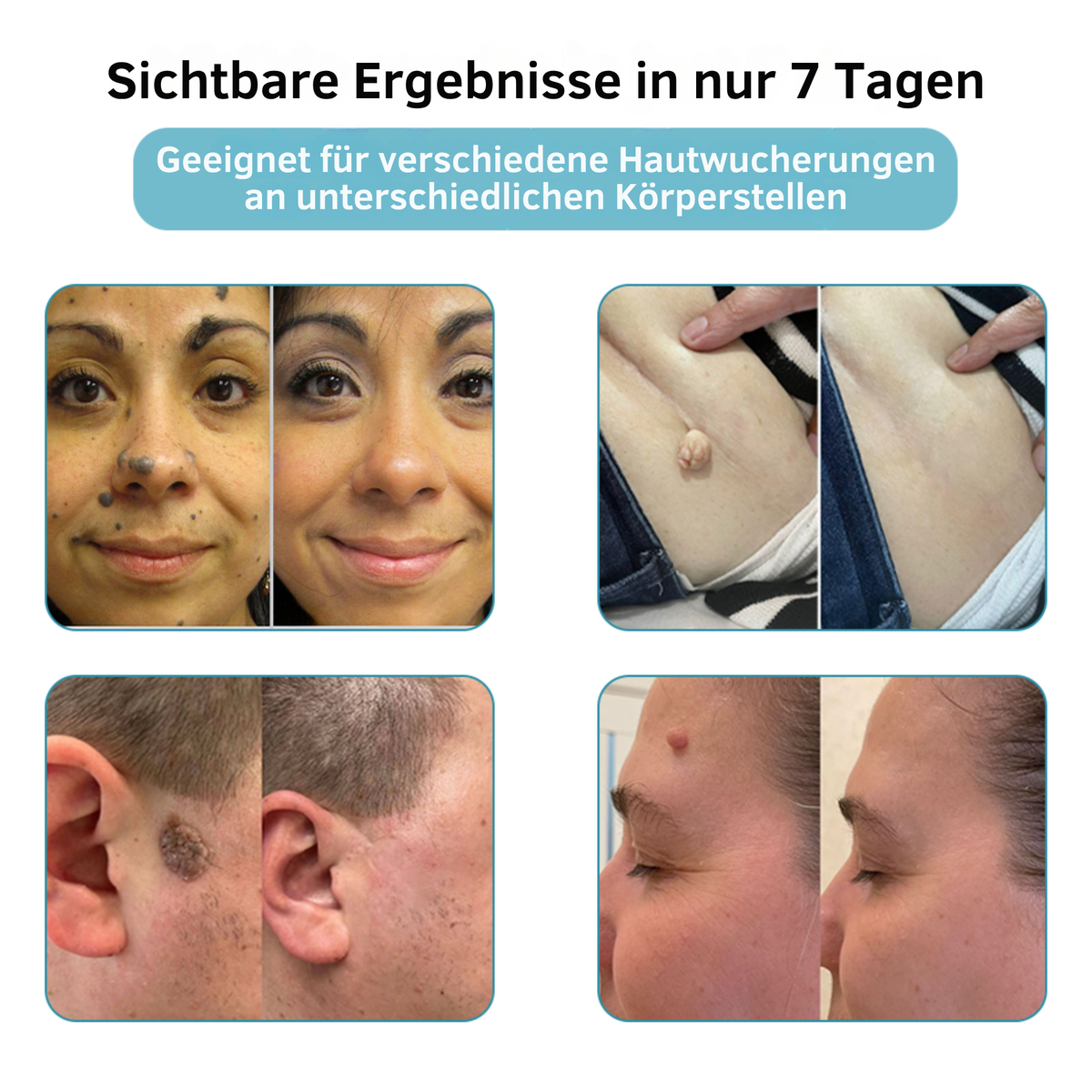 Laser Pen Painless Mole, Skin Tag & Wart Remover
