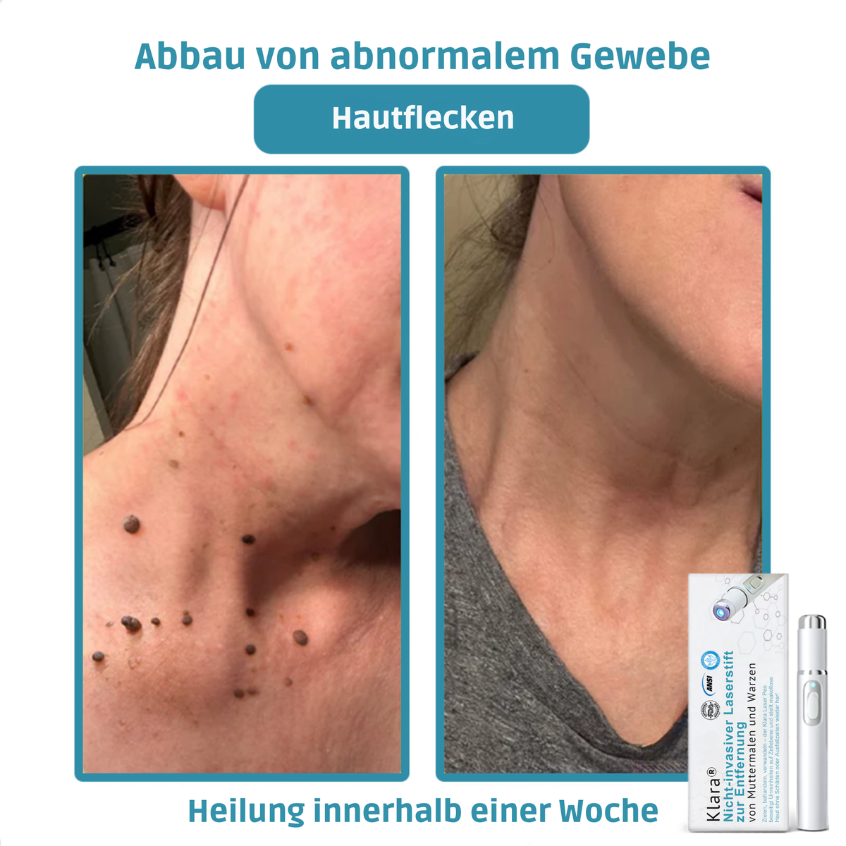 Laser Pen Painless Mole, Skin Tag & Wart Remover