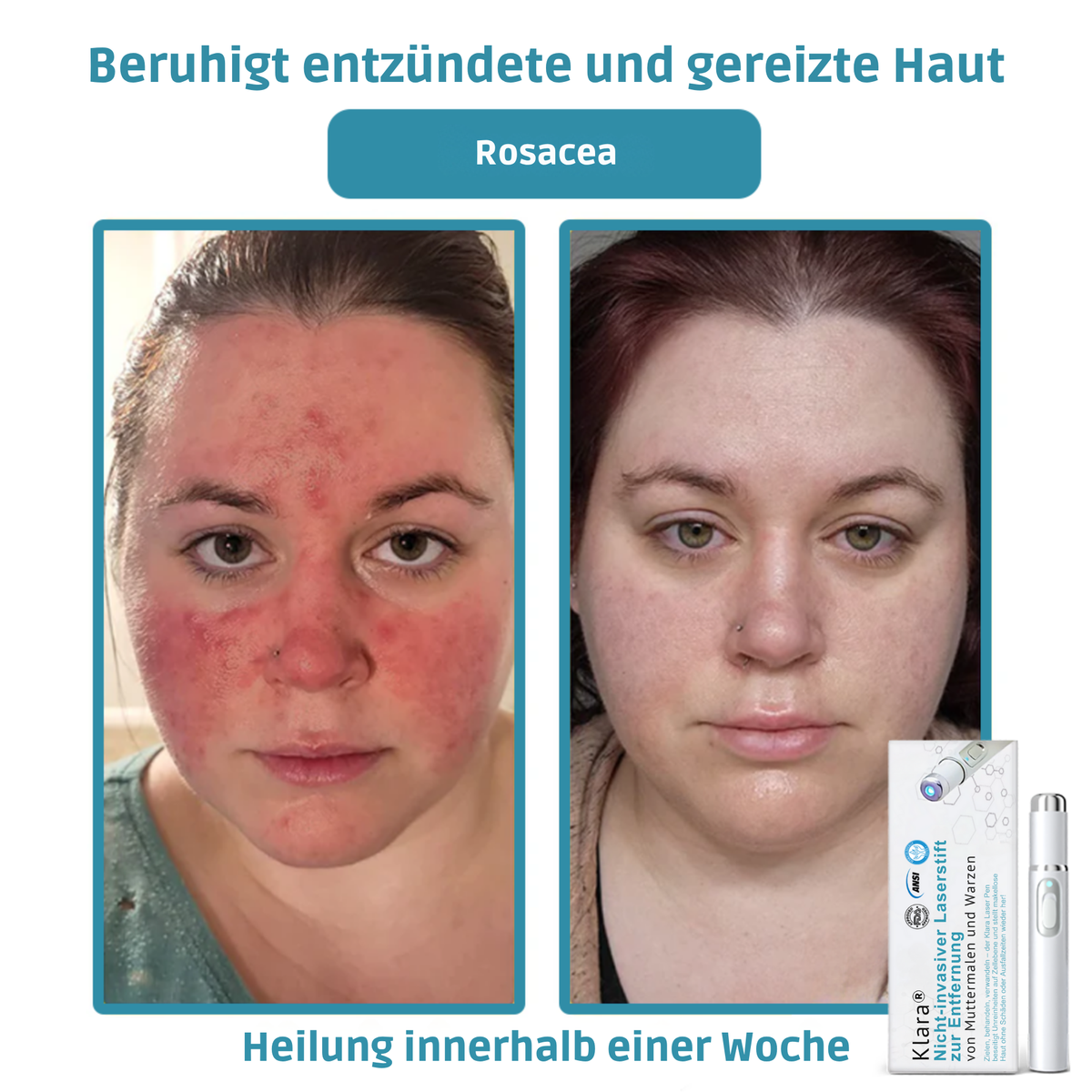 Laser Pen Painless Mole, Skin Tag & Wart Remover