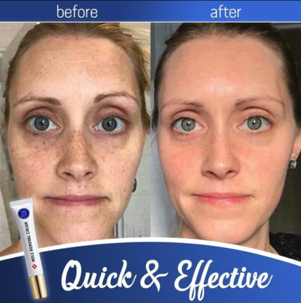 Mole Removal Cream Painless Scar-Free Face & Body