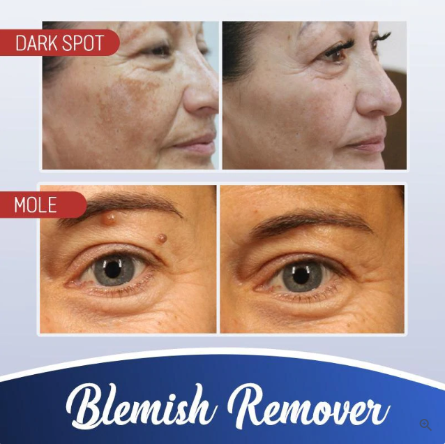 Mole Removal Cream Painless Scar-Free Face & Body
