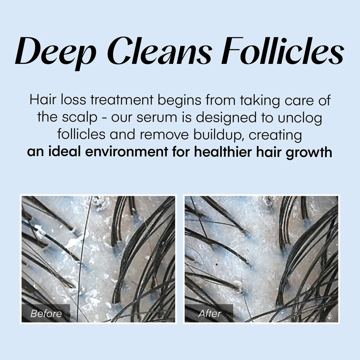 Scalp Serum Roller Applicator Oil Control & Root Strengthening