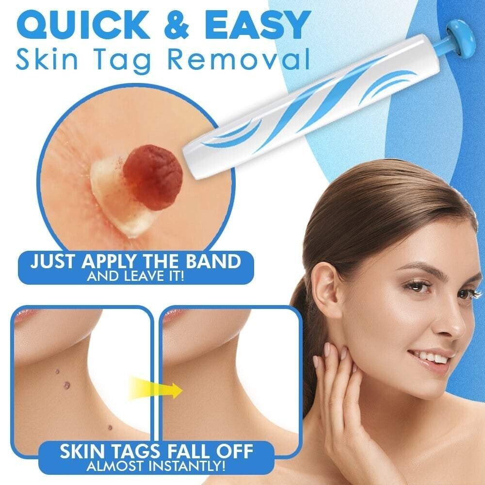 Skin Fibroma Removal Kit Non-Surgical Ligature Bands & One-Handed Applicator